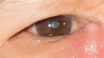 انسداد مجرى الدمع: الأسباب والأعراض وسُبل العلاج