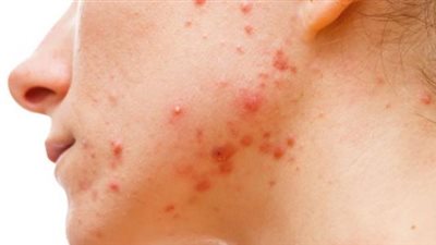 تحت السطح..استراتيجيات فعّالة لإزالة الحبوب تحت الجلد