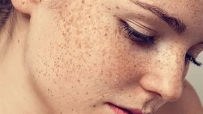 أفضل الحلول لعلاج البقع الداكنة في الوجه.. نصائح وتقنيات 