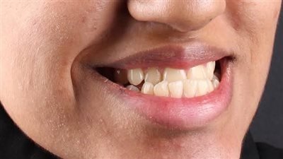 العضة المعكوسة للأسنان وكيفية تقويمها