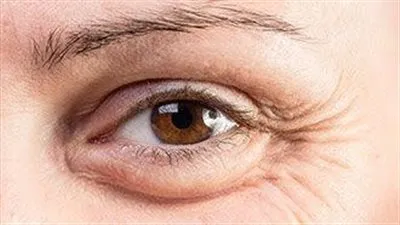 انتفاخ تحت العين.. أفضل الطرق للتخلص منه وتحسن المظهر