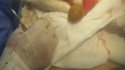 كاد يفقد حياته بسبب ليمونة..مستشفى المنصورة الدولي تنقذ 