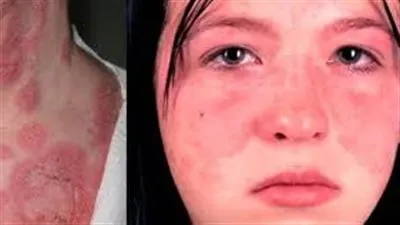 مرض الذئبة الحمراء.. الأسباب والاعراض