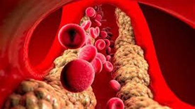 أعراض وأسباب الدهون الثلاثية