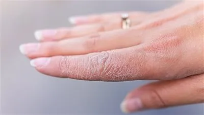 تشقق اليدين.. إرشادات فعّالة للحفاظ على بشرة ناعمة وصحية