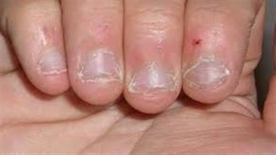 التخلص من عادة أكل الأظافر.. الأضرار والعلاج