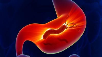 ما هي جرثومة المعدة وما هو علاجها؟