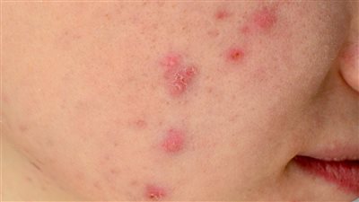 علاج حب الشباب للفتيات بشكل فعال ونهائي