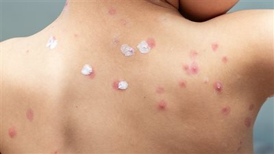 ما هو مرض جدري الماء للأطفال؟.. تعرف الأعراض وطرق الوقاية