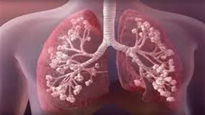 كل ما تريد معرفته عن مرض تليف الرئتين