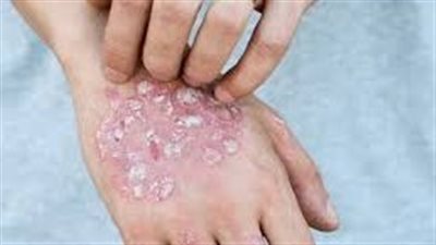 مرض الصدفية وأعراضه وأسبابه وعلاجه