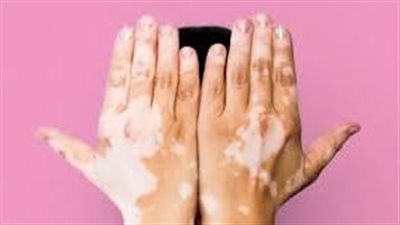 ما هو مرض البهاق؟ وما هي العوامل المساعدة في زيادة احتمالية الإصابة بها؟