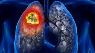 أورام الرئة.. أعراضها وأسبابها وعلاجها