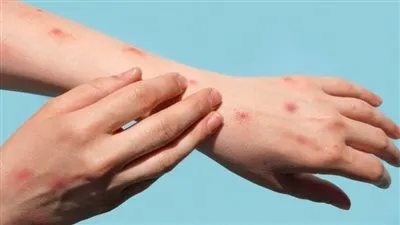 فيروس اليد والقدم والفم عند الاطفال.. الأعراض وطرق الوقاية