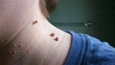 تعرف على أسباب مقاومة الأنسولين في الجسم