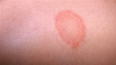 سرطان الجلد.. الأسباب، الأعراض، وسبل الوقاية والتشخيص المبكر