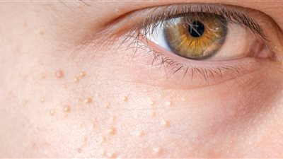 في ثوانِ.. كيفية التخلص من حبوب الوجه بسرعة