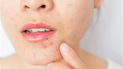 هل ظهور الحبوب من علامات الحمل؟