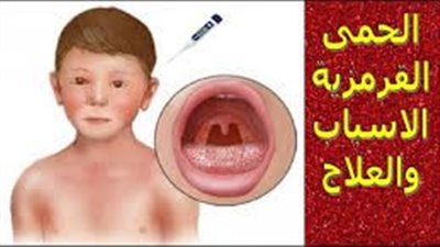 الحمى القرمزية.. تعرف على أسبابها و أعراضها وكيفية التعامل معها