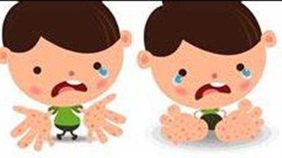 كيفية الوقاية من فيروس اليد والقدم والفم؟