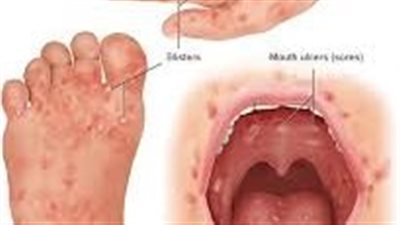 ما هو مرض اليد والقدم والفم الذي يصيب الأطفال؟٠٠ الأعراض وطرق العلاج