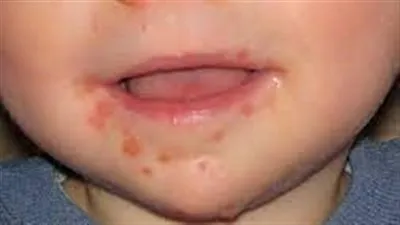 كيفية معالجة فيروس اليد والقدم والفم لدى الأطفال؟