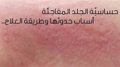 اختبار حساسية الجلد.. انواعها والاثار الجانبية لها
