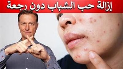 حب الشباب.. اعراضه وطرق علاجه واسباب ظهوره