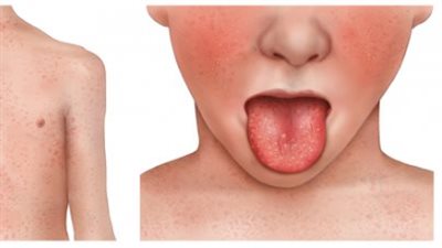  فهم مرض الحمى القرمزية الأعراض والعلاج والوقاية