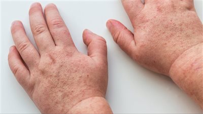 تحذير: الحمى القرمزية خطر يجب تجنبه