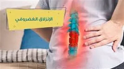 الانزلاق الغضروفي.. تعرف عليه وعلى طرق تجنب الإصابة به