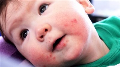 تعرف على فيروس اليد والفم والقدم 