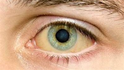 إليك طريقة علاج صفار العين