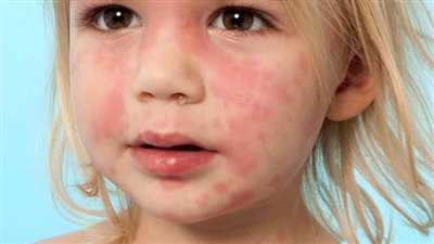 فيروسات معدية وهذه أعراضها.. تحذيرات من انتشار الجدري المائي والمخلوي (فيديو)