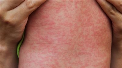 مرض الحصبة..مرض معدي يتطلب الوقاية والتوعية 