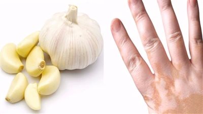 البهاق.. ( أفضل الطرق لعلاج البهاق بالأعشاب)