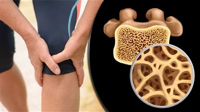 آلام هشاشة العظام.. ( أسبابها وطرق العلاج)