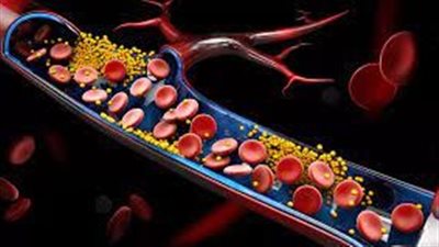 ارتفاع الكوليسترول خطر يهدد الحياة.. أعرف علاجه
