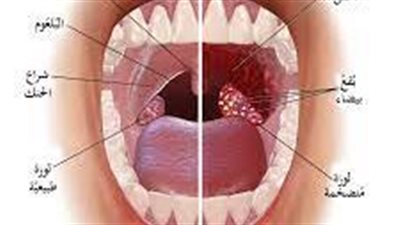 التهاب الحلق: أسبابه وطرق فعّالة للعلاج 