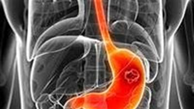 سرطان المعدة.. الأسباب والأعراض والعلاج ( تفاصيل )