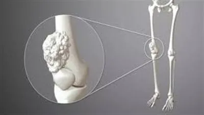 سرطان العظام.. تعرف على انواع سرطان العظام وأسبابه وعلاجه