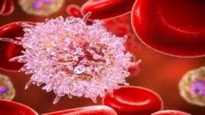 سرطان الدم الليمفاوي الحاد… الأسباب والأعراض والعلاج