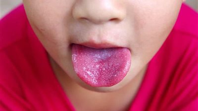 تعرف على أسباب الحبوب الحمراء على لسان الطفل