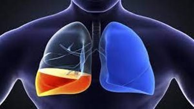 الماء على الرئة: أسبابه وأعراضه 