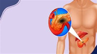 غثيان وقيء.. أبرز أعراض حصوة المرارة