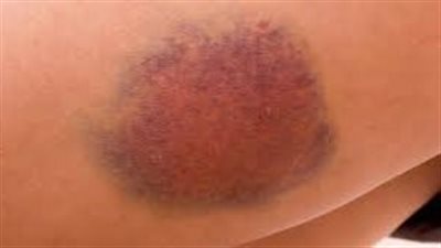 لون غامض.. فهم أسباب ظهور البقع الملونة على الجسم وكيفية التعامل معها