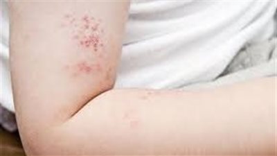 أعراض الحزام الناري وسبل فعالة لعلاجه