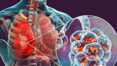 البكتيريا الرئوية: تحدياتها وأثرها على الصحة البشرية 