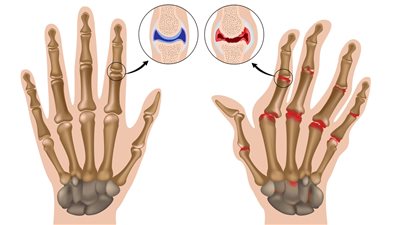 تعرف على آلام العظام الروماتيزم وطرق علاجها