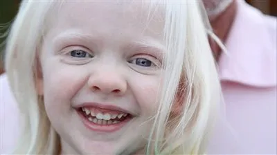 مرض المهق: تحديات صحية تتطلب فهمًا ودعمًا